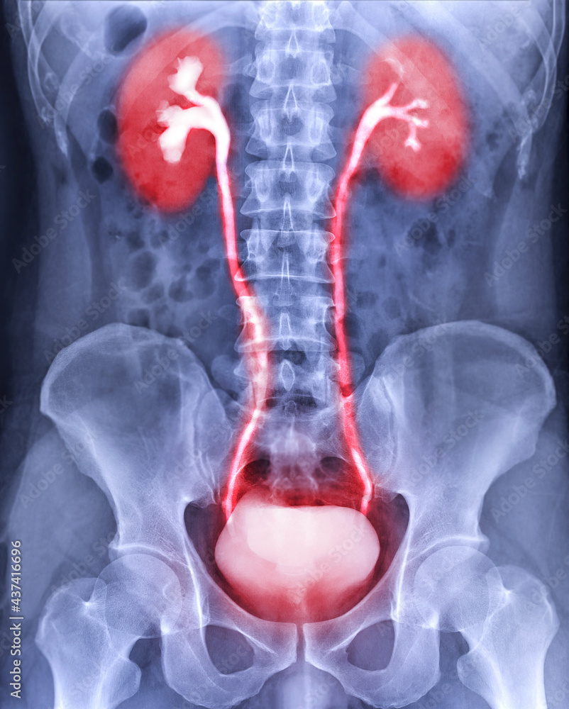 Poster intravenous pyelogram or i.v.p showing of urinary tract after injection contrast media agent 25 minu