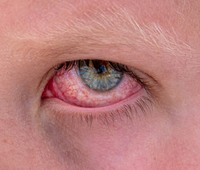 Close up of a boy's red eyes.