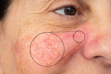 Woman's face showing redness due to fragile capillaries