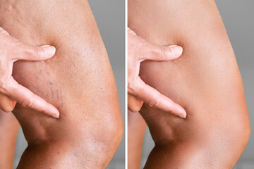 Leg Vein Varicose Before