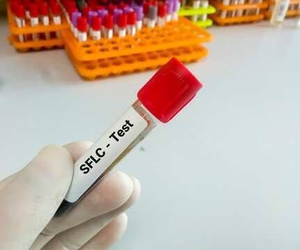 Blood sample for Serum Free Light Chain test. diagnosis for plasma cell disorders 