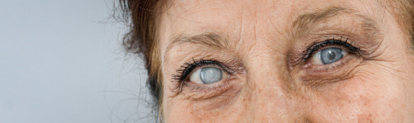 old woman  sick eye detail