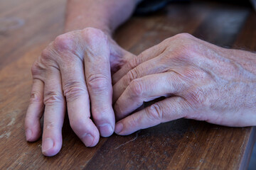 The hands of a man with psoriatic arthritis on a wooden table.