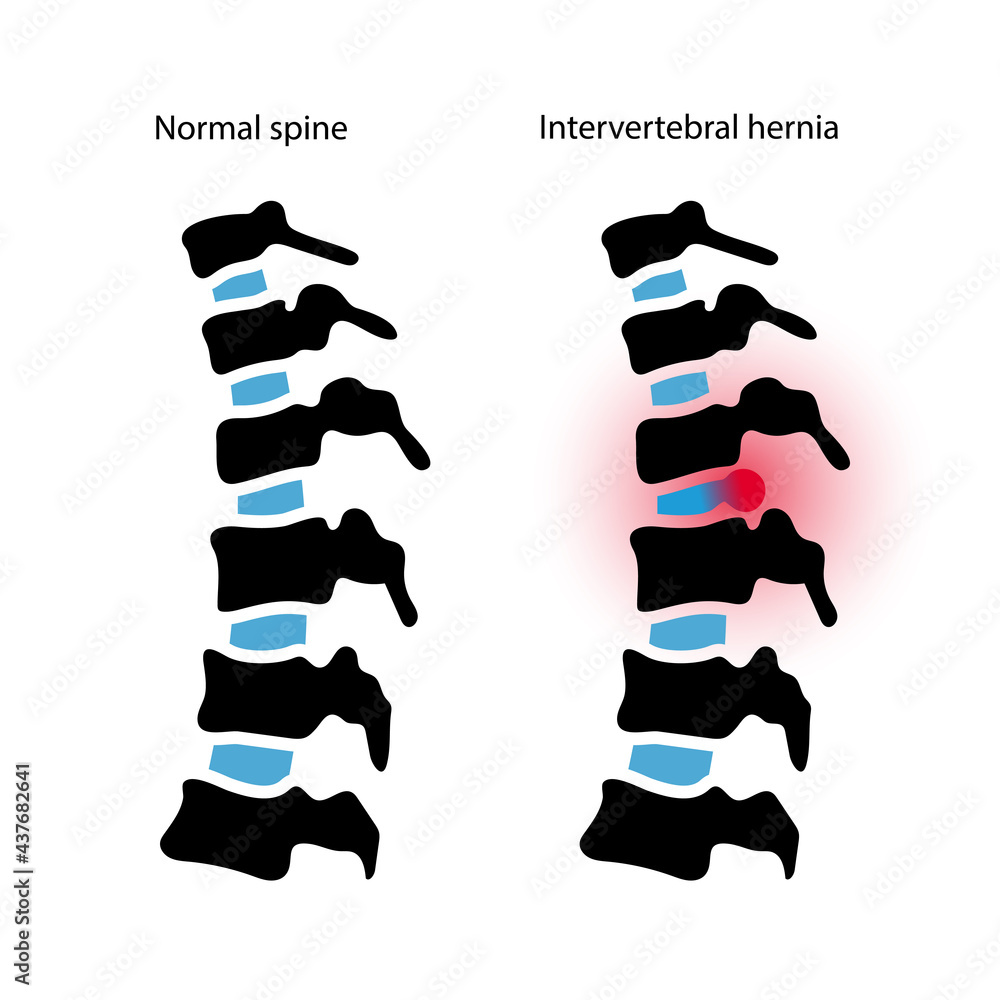 Poster intervertebral hernia concept