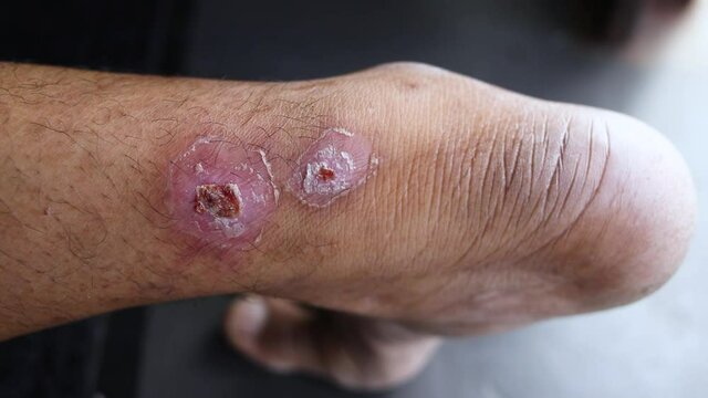 Leg ulcers, Skin disease, which is caused by allergic ulcers,