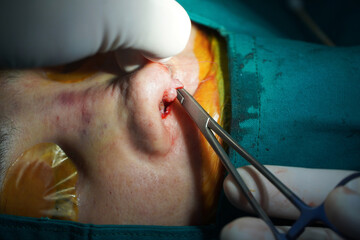 doctor and team  use tools  sutures around the nose  to finish nose surgery