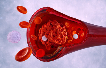 Blood cells clot in the human body blood vessels. Artery, vein blockage with coagulated cells, deep vein thrombosis health risk. Thrombus, embolus, embolism, blood flow 3d medical science illustration