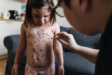 Toddler girl with chickenpox measles on the body. Varicella virus childhood contagious disease....