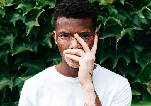 Portrait of a Black man with vitiligo