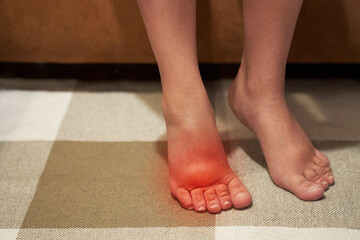 Woman with swelling on the legs, tired and pain in the legs, swelling during pregnancy. High...