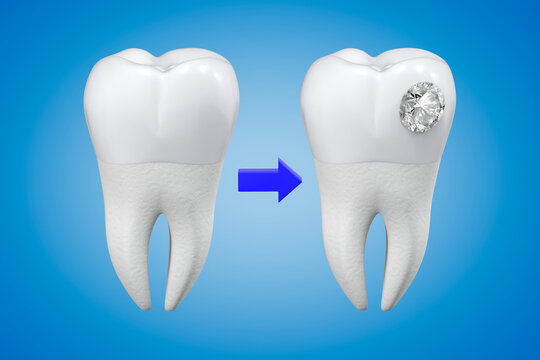 An exaggerated example of a diamond tooth decoration procedure. Aesthetic dentistry. 3d rendering.