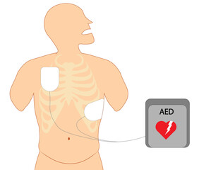 Defibrilator electrode position. Electrode chest position to defibilator shock.