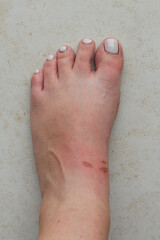 Woman's foot with Bloody Wounds caused by corns. Problem of many people after wearing a new sandals in summer. 