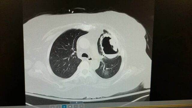 Vasculitis with cavitary pneumonia on chest CT
