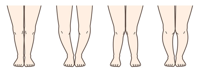 変形性膝関節症　図解