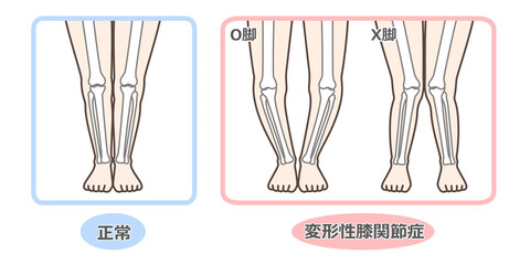 変形性膝関節症　図解