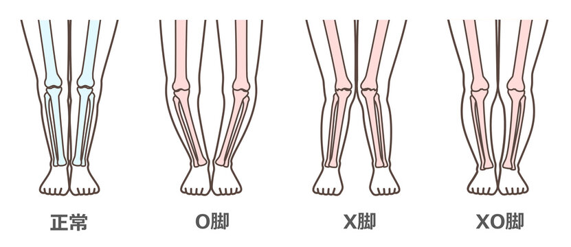 変形性膝関節症　図解