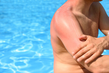 A man applies sunburn cream to reddened skin from sunburn in front of a swimming pool
