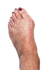 Hallux valgus, bunion on elderly woman's foot isolated on white background. Toe joint deformity with toe misalignment. Concept of painful orthopedic diagnosis. Closeup, top view, dorsal.
