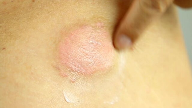 Man applying skin ointment on psoriasis wound , in studio Chiangmai  Thailand