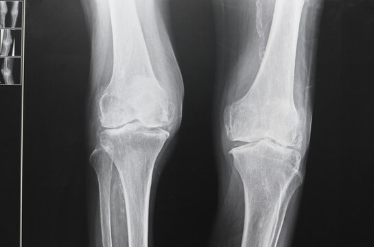 x ray image of knee. X-ray of the knee joint, x-ray shown calcific of vascular. Healthcare and medical concept.