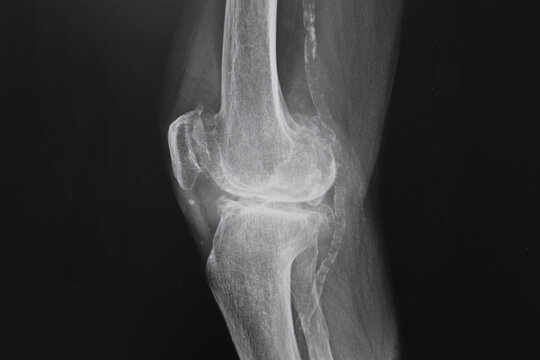 x ray image of knee. X-ray of the knee joint, x-ray shown calcific of vascular. Healthcare and medical concept.