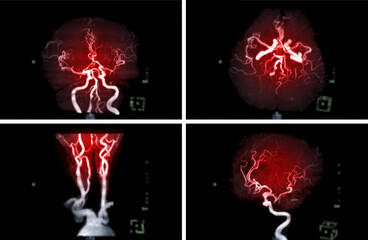 Compare of MRA Brain or Magnetic resonance angiography ( MRA )  of cerebral artery and common carotid artery AP and Lateral View  for evaluate them  stenosis  and stroke disease.