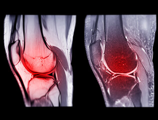 Magnetic resonance imaging or MRI knee comparison sagittal PDW and TIW view for detect tear or...