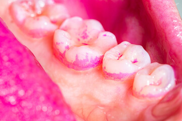 Concept of deep and detailed cleaning of the teeth. Pink disclosing tablets or gel for reveal and...