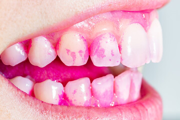 Concept of deep and detailed cleaning of the teeth. Pink disclosing tablets or gel for reveal and...