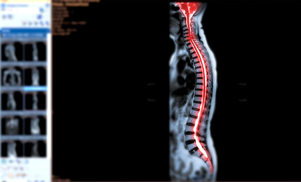 MRI of whole spine  T2W sagittal  plane for diagnostic Spinal Cord Compression.