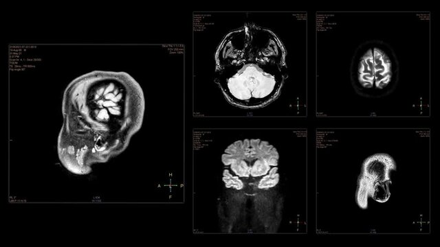 Head MRI scan from different angles. Top view and side view of brain MRI scan with hundreds of slices