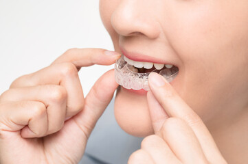 Asian woman wearing orthodontic silicone trainer. Mobile orthodontic appliance for dental...