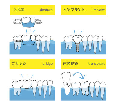 インプラントと入れ歯とブリッジと歯の移植の歯科治療方法の違い