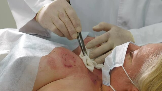 Doctor disinfecting and treating burned skin wound on chest area in emergency. Surgeon team working with burn skin on breast. Medical worker debriding wound with cotton pads wetted with solution. 4 k