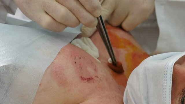 Doctor disinfecting and treating burned skin wound on chest area in emergency. Surgeon team working with burn skin on breast. Medical worker debriding wound with cotton pads wetted with solution. 4 k