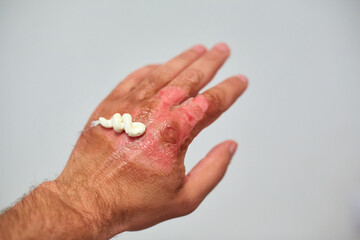 use of healing ointment after burns, first aid for body burns