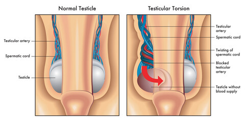 Medical illustration shows a normal testicle and one affected by testicular torsion, with annotations. - obrazy, fototapety, plakaty