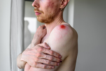 Naklejka premium Man with many wounds on skin hugging yourself. Domestic violence, accident, fight concept