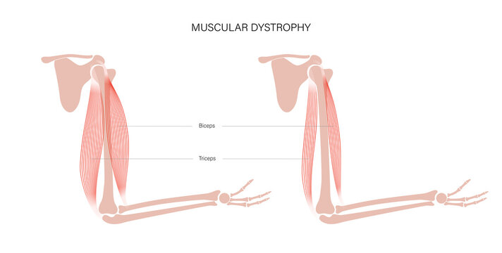 Muscular dystrophy of arm