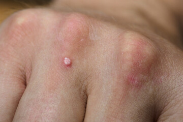 White dots on the skin on the hands together.