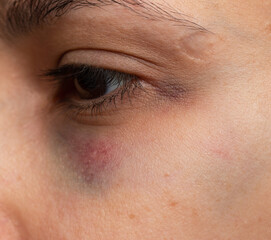 Fototapeta na wymiar hematoma under the eye on the skin as a background