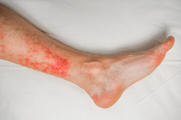 Disease of the skin on the legs, itchy red rashes and spots
