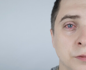 Fototapeta premium Close up of two annoyed red blood eyes of male affected by conjunctivitis or after flu, cold, allergy. Copy space for advertisement. Tired eyes after working at the computer. Close-up videos and macro