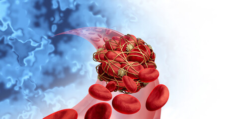 Blood clots health risk or thrombosis medical illustration concept symbol as a group of human blood cells clot clumped together by sticky platelets and fibrin as a blockage in an artery or vein - obrazy, fototapety, plakaty