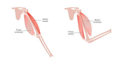 Muscular dystrophy of arm