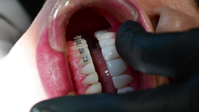 Orthodontist places dental braces in a patient&rsquo;s mouth