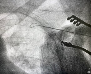 X ray image during permanent pacemaker implantation procedure.	