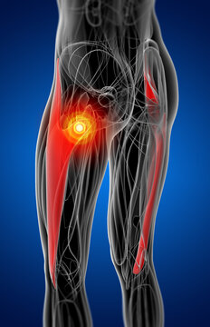 medical  illustration of the  tensor fascia lata