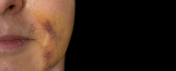 Unrecognizable woman face with bruises against black background